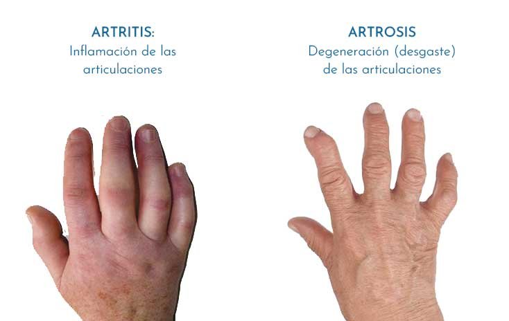 Artritis – Artrosis y Osteoporosis